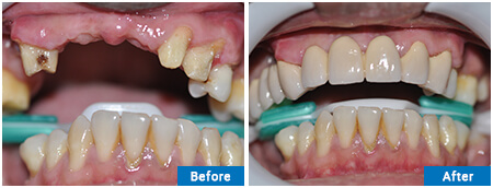 ZIRCONIA BRIDGE